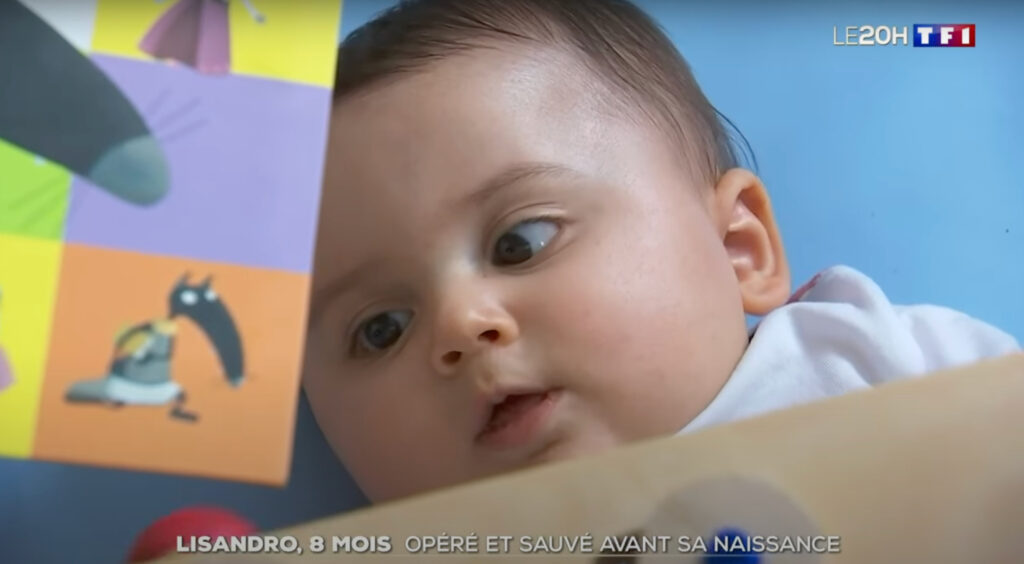 Photo de Lisandro diffusé sur TF1 opéré d'un anévrisme grâce à la chirurgie foetale diagnostiqué par le Dr Calvo