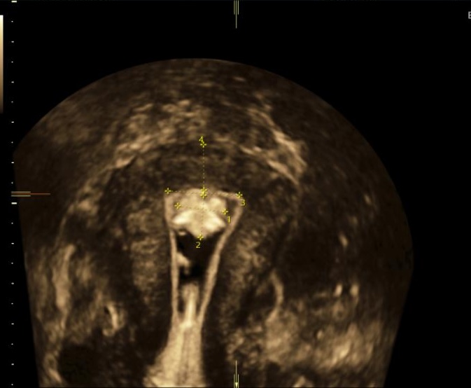 échographie pelvienne